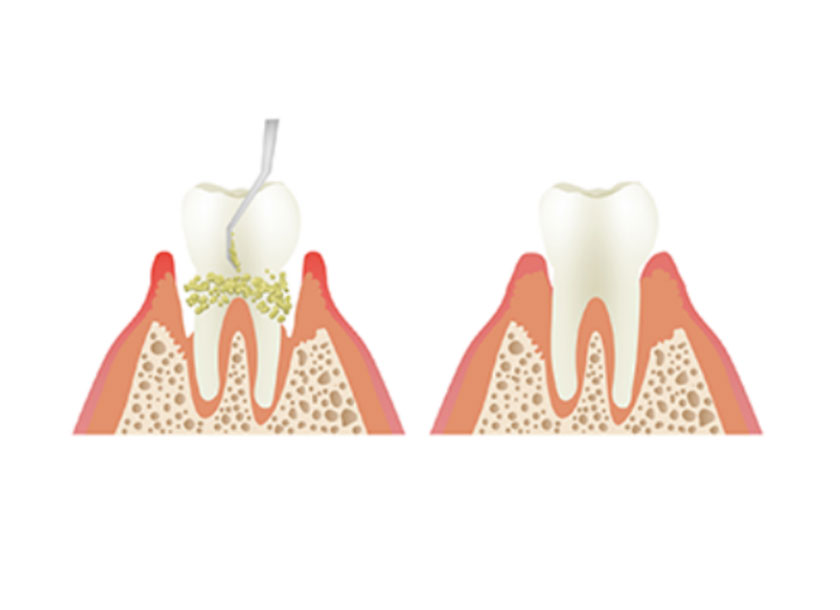 SRP（スケーリング・ルートプレーニング）