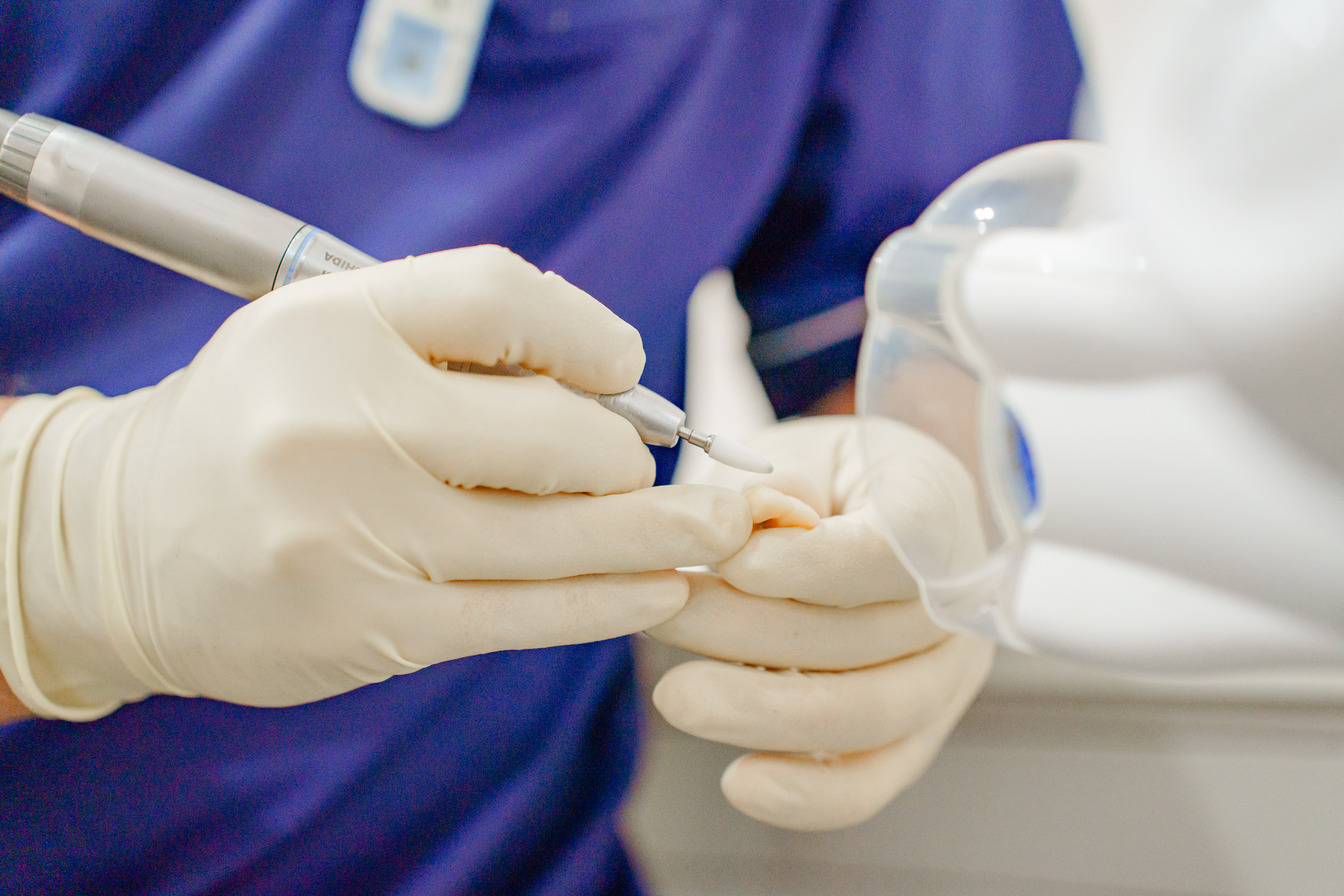 詰め物・かぶせ物