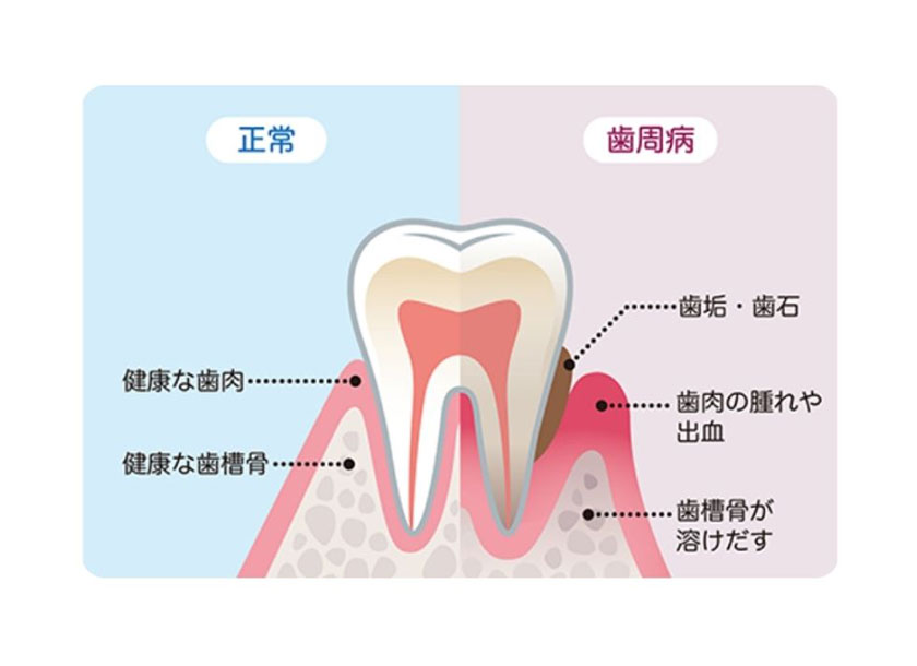 歯周治療について